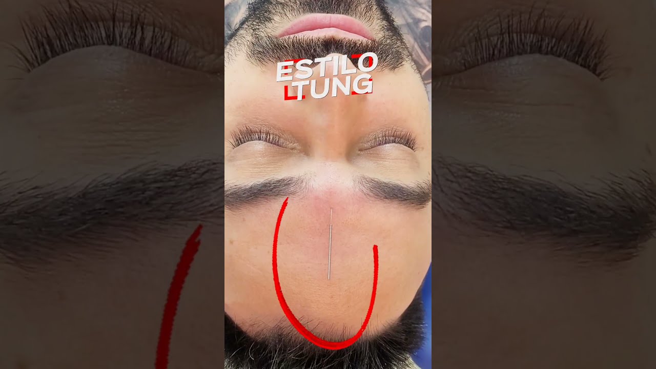 cuantas sesiones de acupuntura son necesarias para la ansiedad